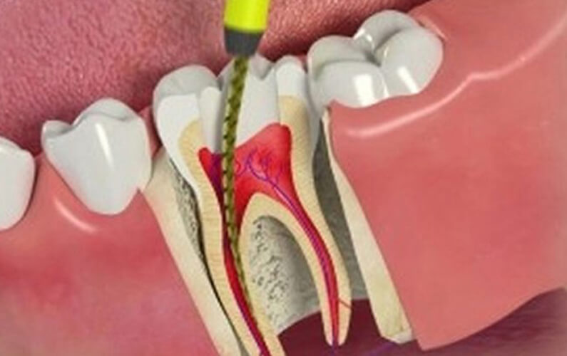 Post Root Canal Tips Which May Help You