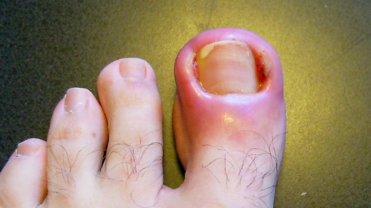 Protect Your Toenails by Knowing the Signs and Causes of Toenail Infection