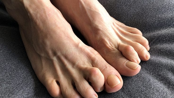 All You Need to Know About Hammertoes