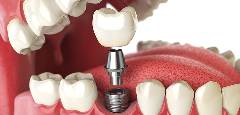 What Is Dental Implant – Retained Dentures and How Is It Beneficial?