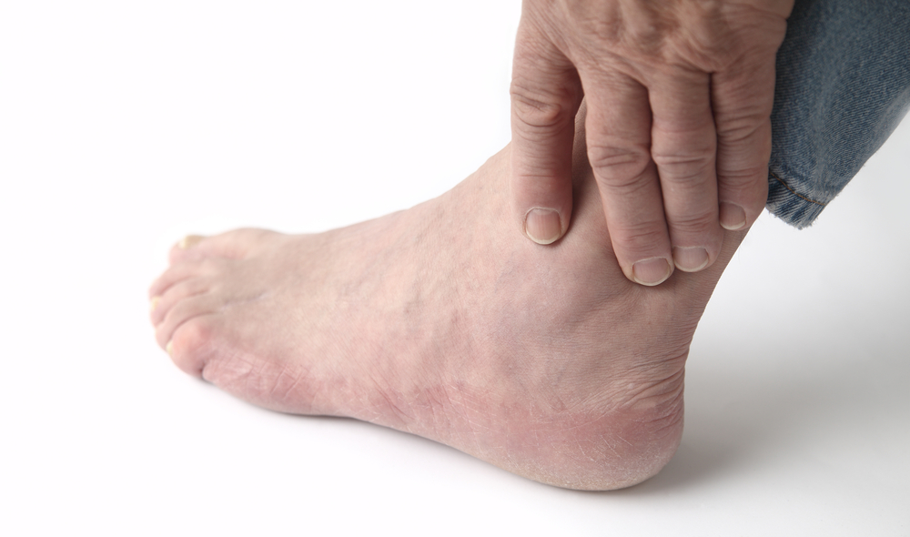 What Are the Symptoms and Causes of Gout?