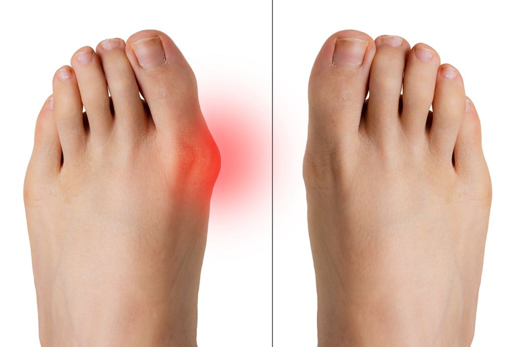 Learn About the Causes, Symptoms, and Treatment of Bunion