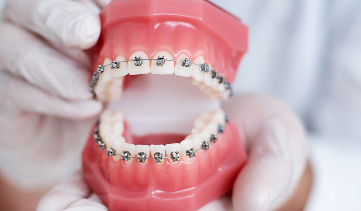 Are Braces Helpful for Teeth?