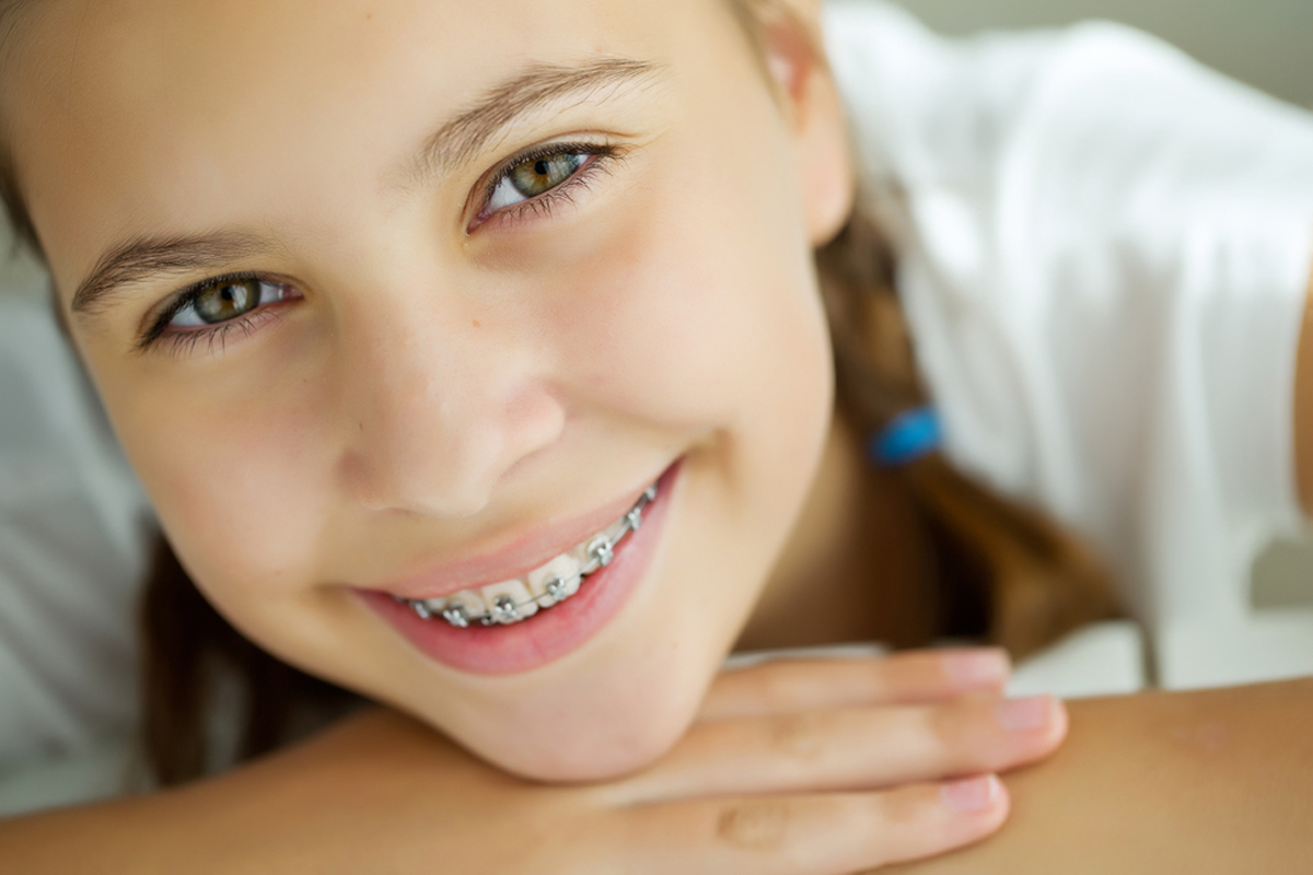 The 5 Types of Braces Orthodontists Use These Days
